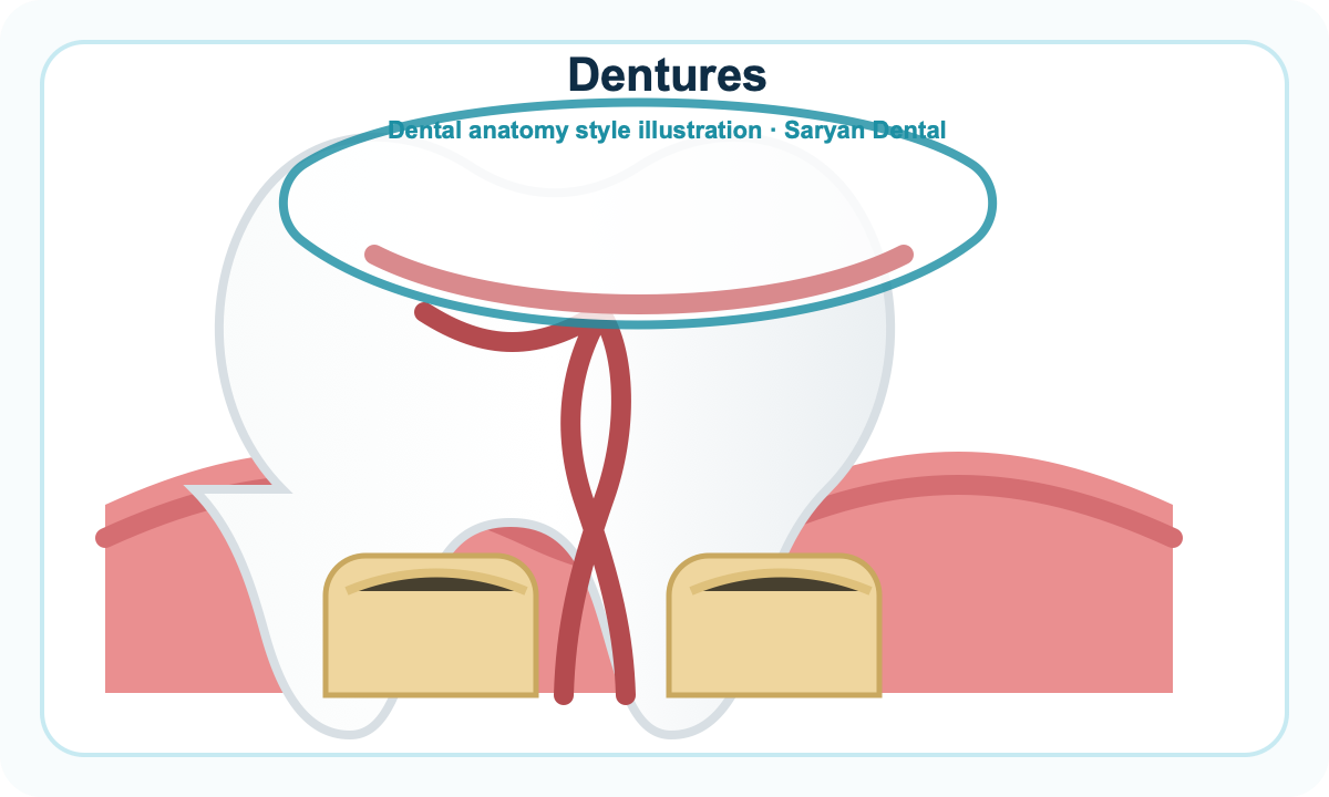 Dental anatomy illustration for Dentures at Saryan Dental in Glendale