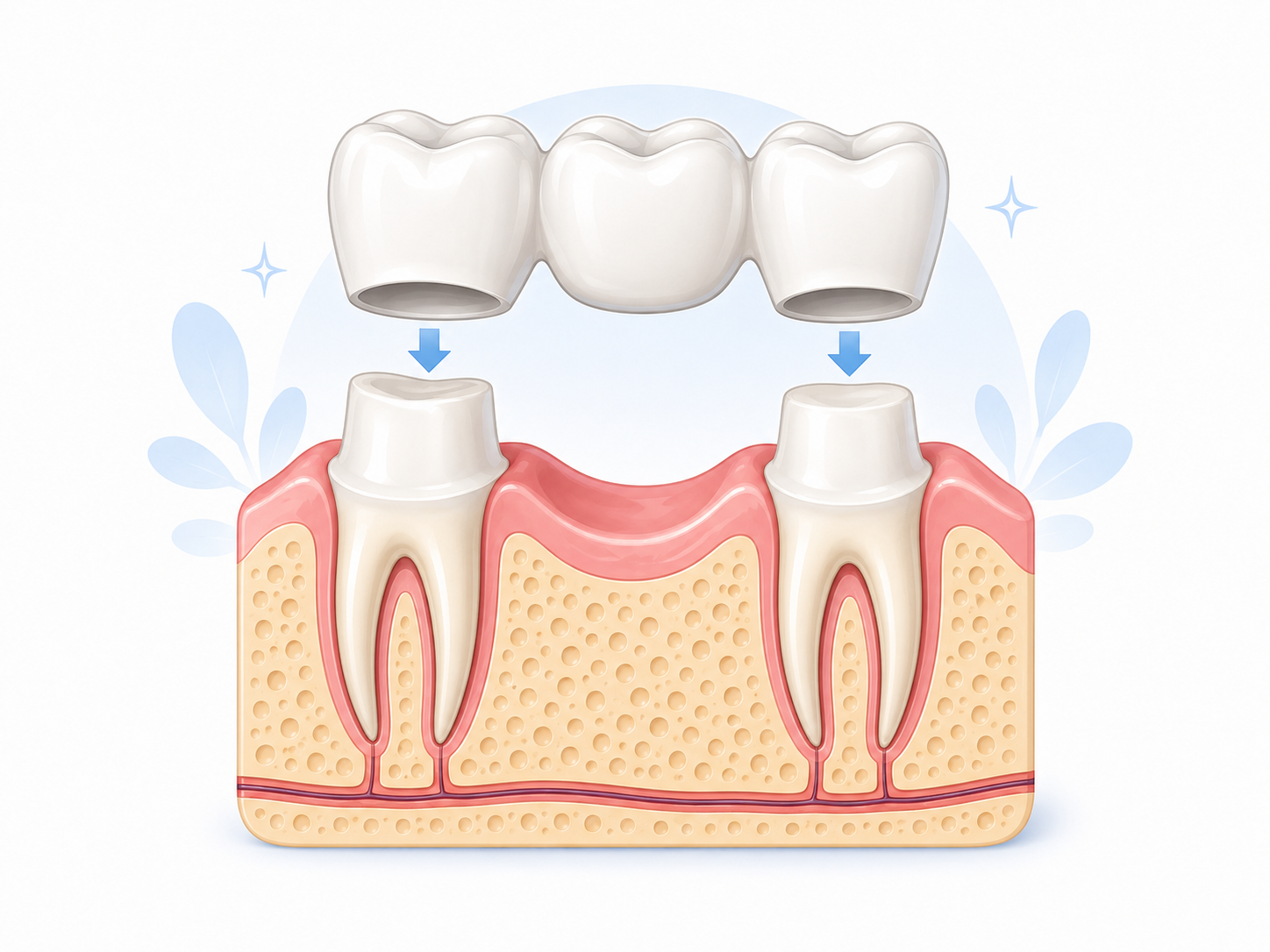 Dental bridge illustration showing a bridge restoration placed over prepared support teeth