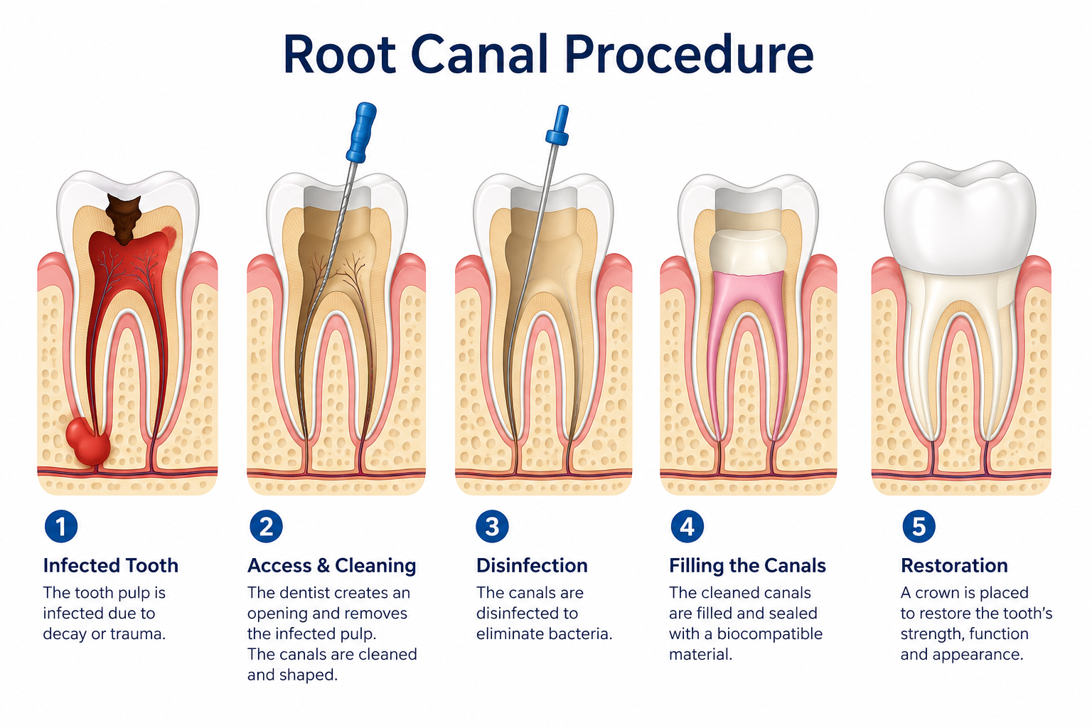 Root canal procedure infographic showing infection removal, canal cleaning, filling, and tooth restoration