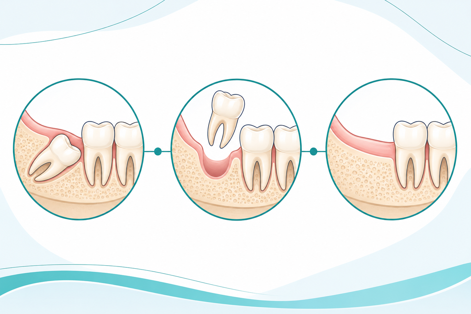 Illustration showing impacted wisdom tooth removal and healed gum after extraction